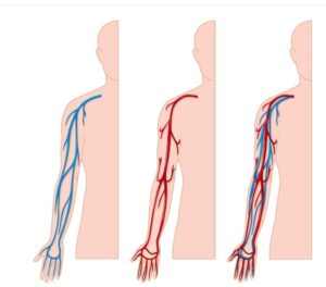 chirurgie vasculaire